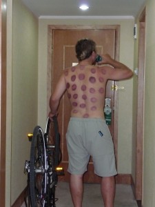 Kevin enjoying a beer after his massage and cupping.  Probably not the best combination?  but it looks like it hurt...